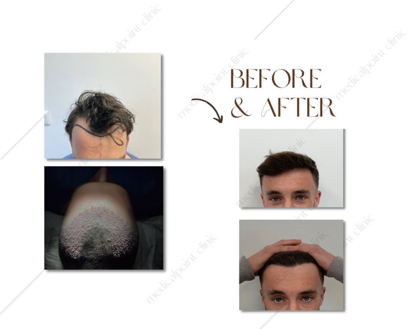 Haartransplantatie voor en na