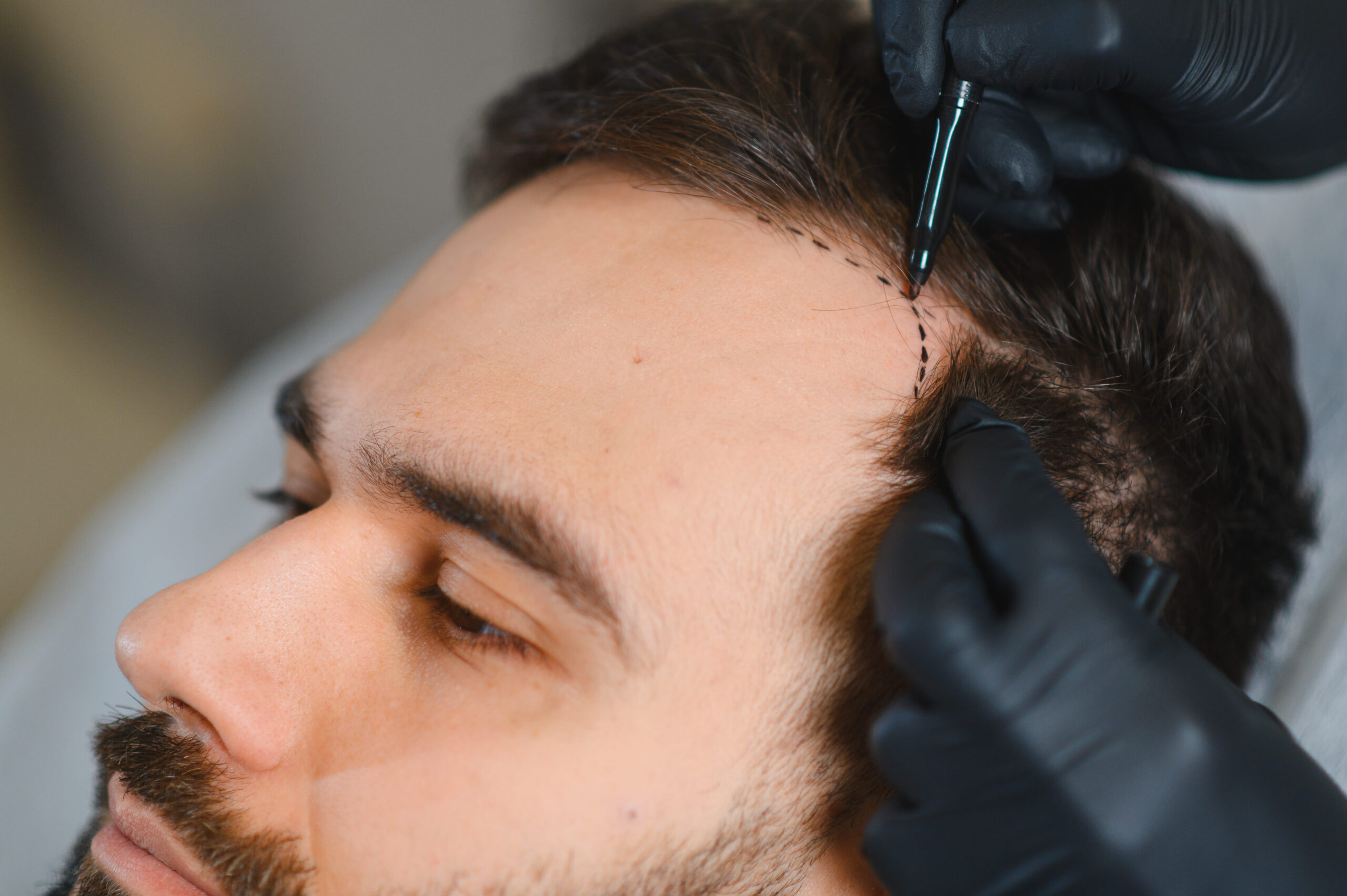 Haartransplantatie Amsterdam